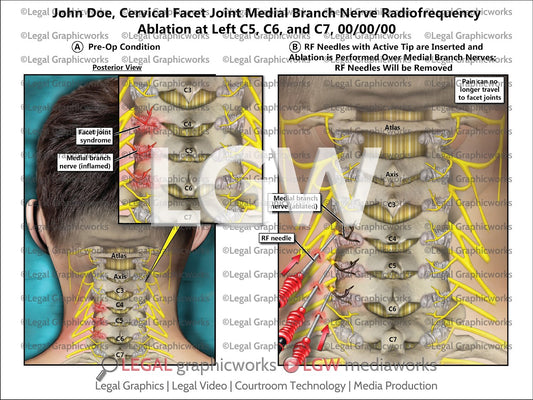 Cervical Facet Joint Medial Branch Nerve Radiofrequency Ablation at Left C5, C6, and C7