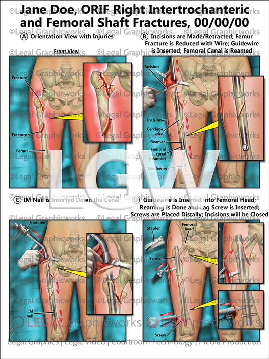 ORIF Right Intertrochanteric and Femoral Shaft Fractures