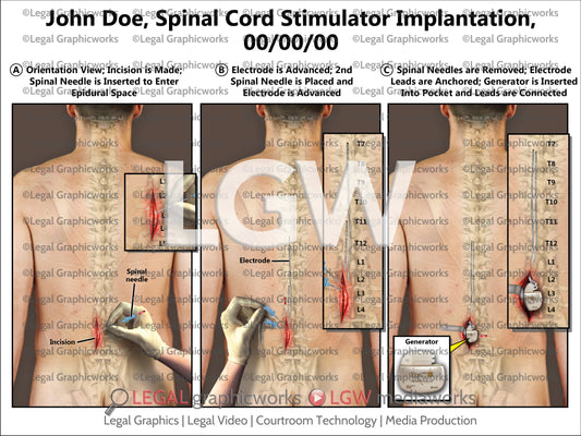 Spinal Cord Stimulator Implantation
