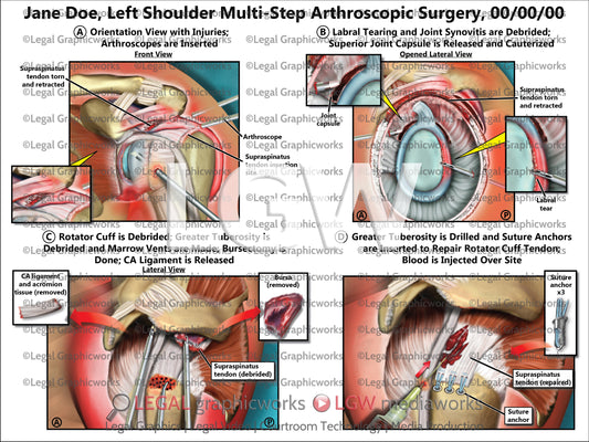Left Shoulder Multi-Step Arthroscopic Surgery