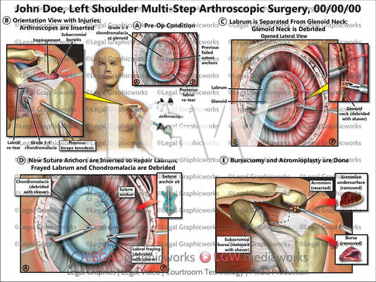 Left Shoulder Multi-Step Arthroscopic Surgery