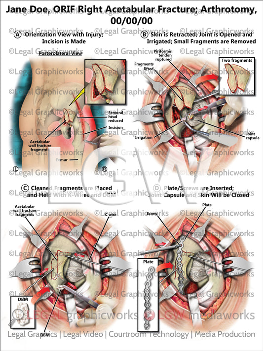 ORIF Right Acetabular Fracture; Arthrotomy