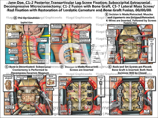C1-2 Posterior Transarticular Lag Screw Fixation; Suboccipital Extracranial Decompressive Microcraniectomy; C1-2 Fusion with Bone Graft, C5-7 Lateral Mass Screw/Rod Fixation with Restoration of Lordotic Curvature and Bone Graft Fusion