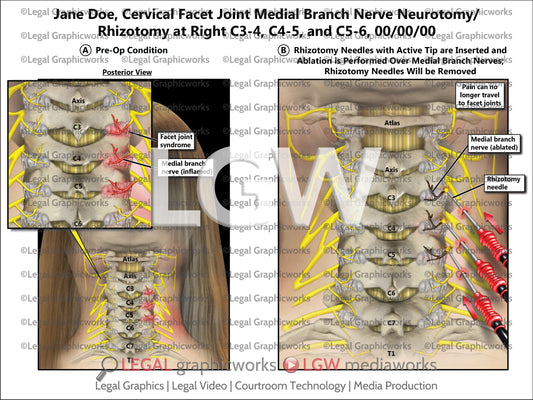 Cervical Facet Joint Medial Branch Nerve Neurotomy/Rhizotomy at Right C3-4, C4-5, and C5-6