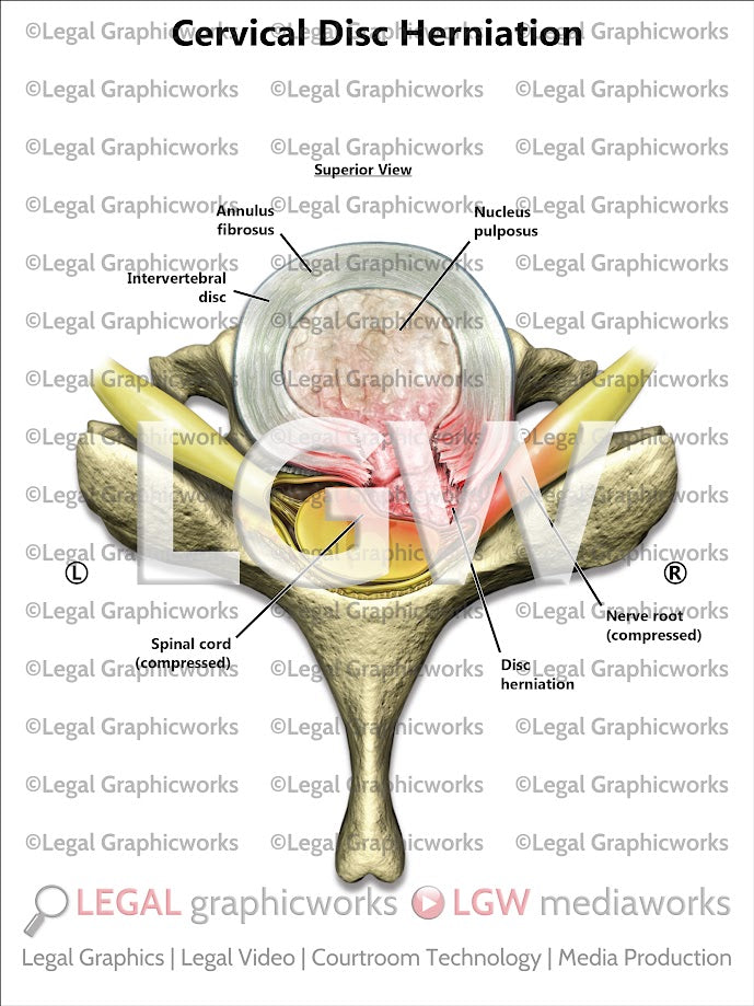Cervical Disc Herniation