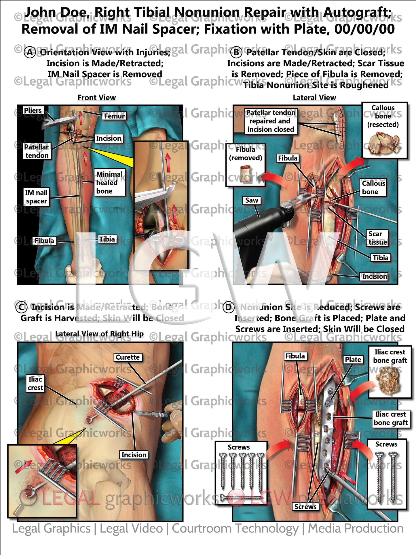 Right Tibial Nonunion Repair with Autograft; Removal of IM Nail Spacer; Fixation with Plate