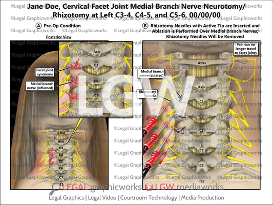 Cervical Facet Joint Medial Branch Nerve Neurotomy/Rhizotomy at Left C3-4, C4-5, and C5-6