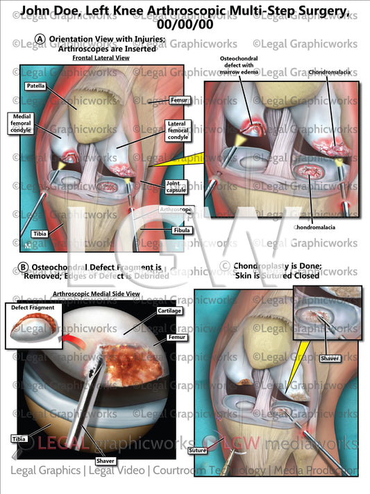 Left Knee Arthroscopic Multi-Step Surgery
