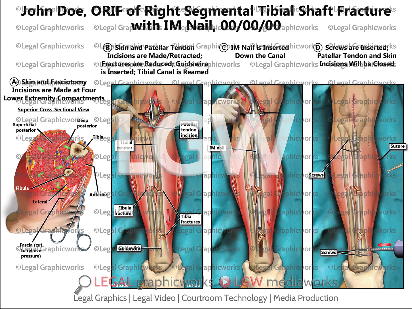 ORIF of Right Segmental Tibial Shaft Fracture with IM Nail