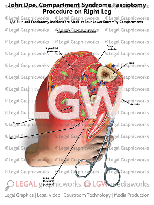 Compartment Syndrome Fasciotomy Procedure on Right Leg