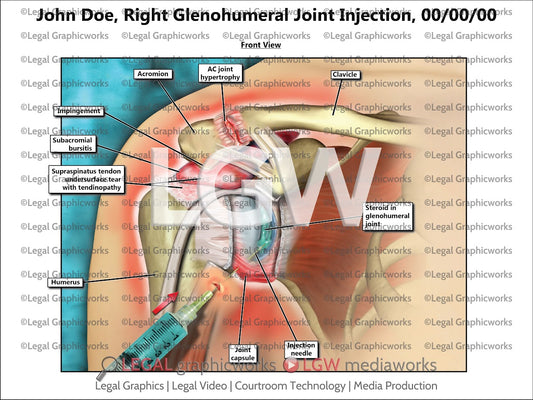 Right Glenohumeral Joint Injection