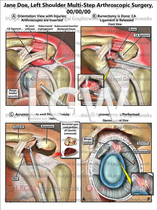 Left Shoulder Multi-Step Arthroscopic Surgery