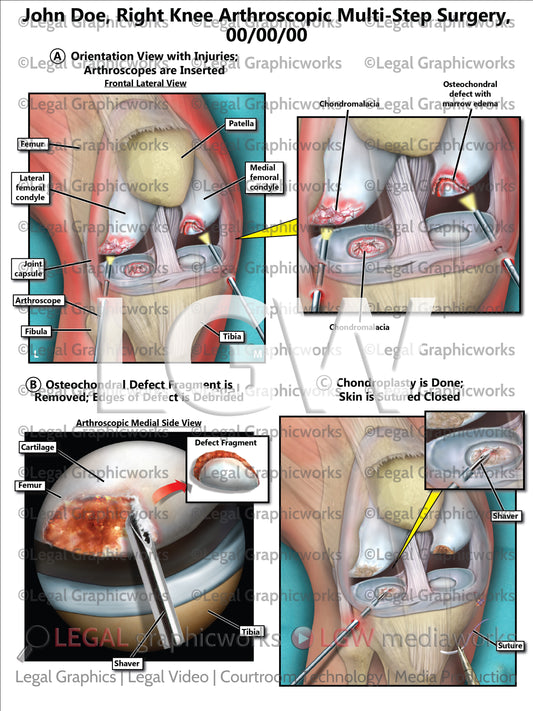 Right Knee Arthroscopic Multi-Step Surgery