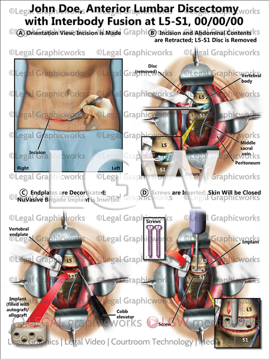 Anterior Lumbar Discectomy with Interbody Fusion at L5-S1