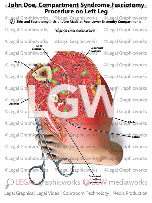 Compartment Syndrome Fasciotomy Procedure on Left Leg