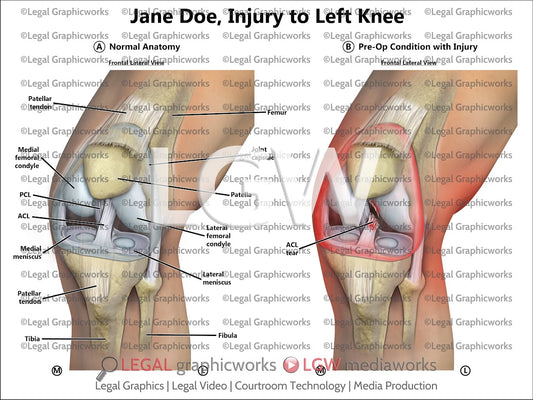 Injury to Left Knee