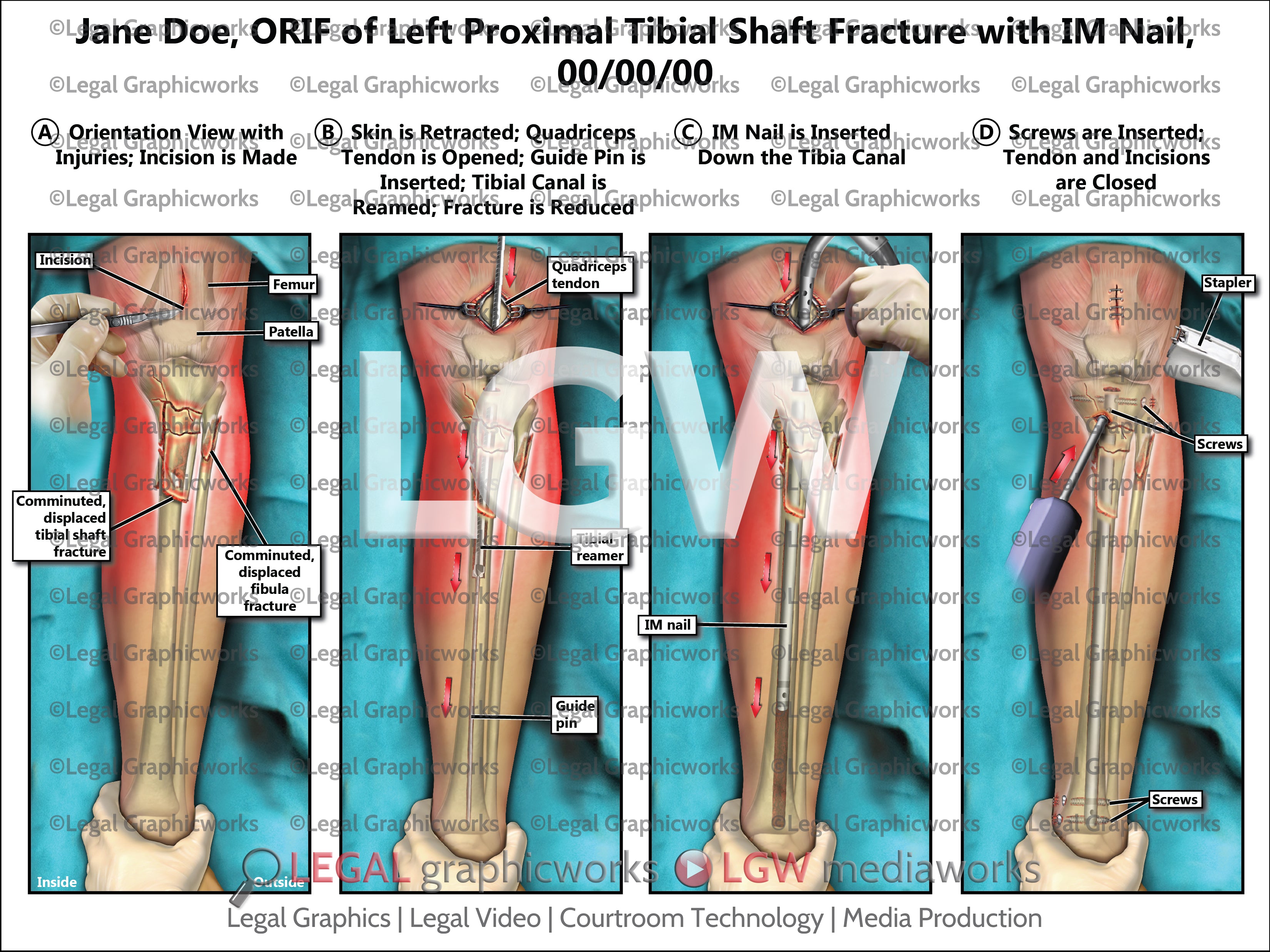 ORIF of Left Proximal Tibial Shaft Fracture with IM Nail – LGWgo