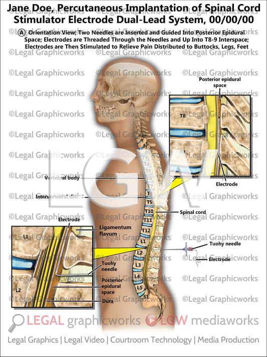 Percutaneous Implantation of Spinal Cord Stimulator Electrode Dual-Lead System