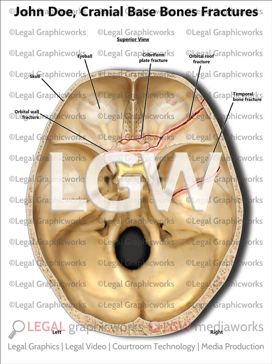 Cranial Base Bones Fractures