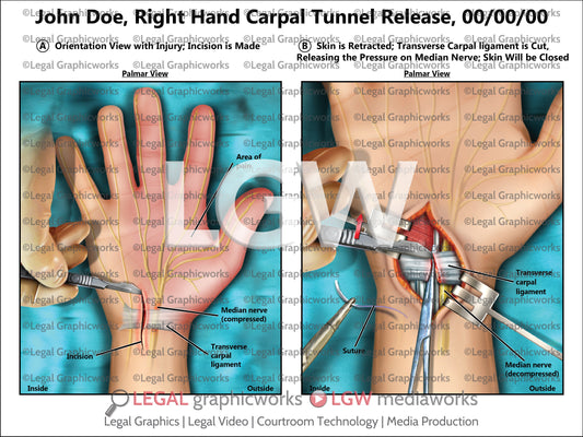 Right Hand Carpal Tunnel Release