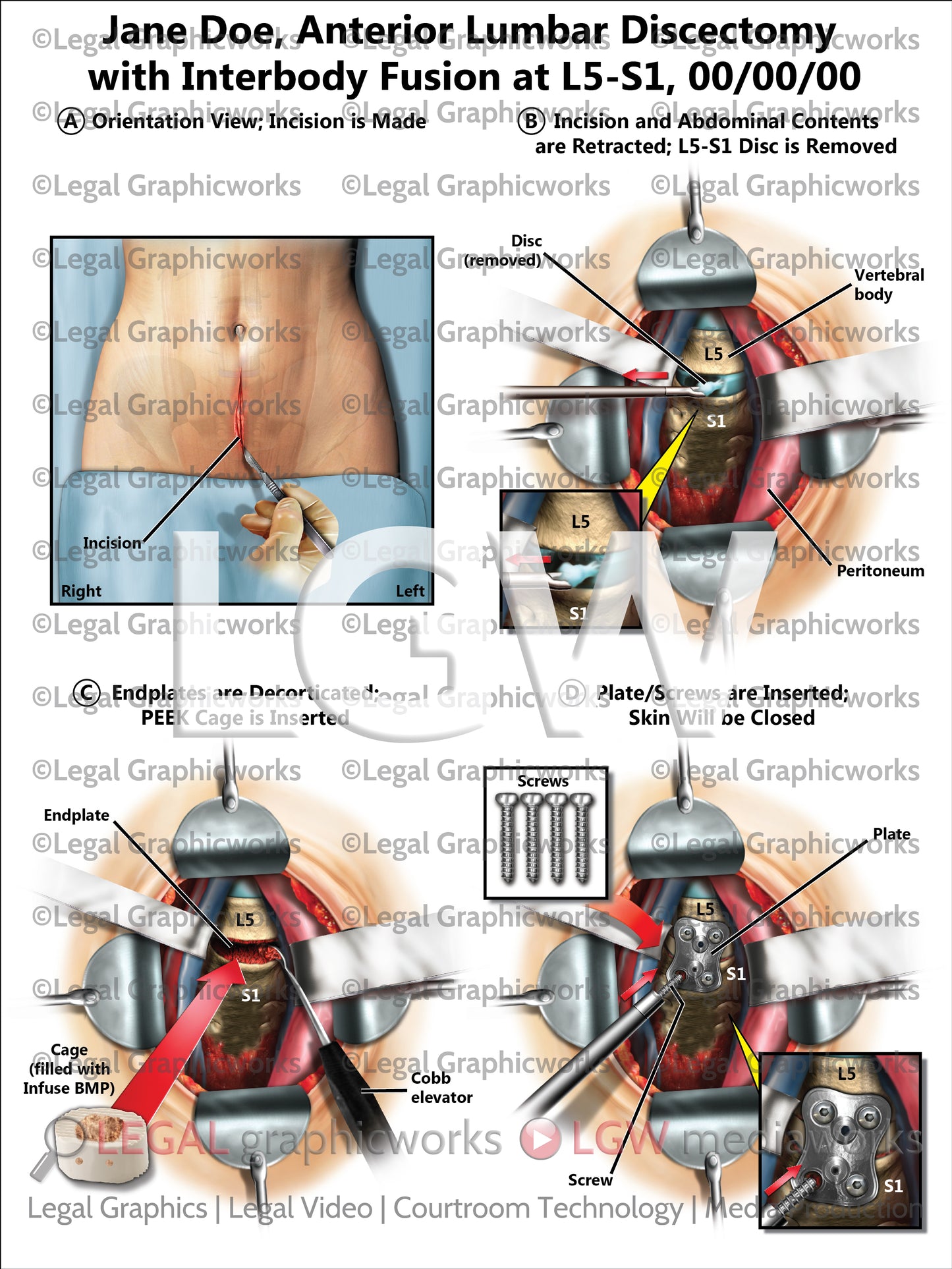 Anterior Lumbar Discectomy with Interbody Fusion at L5-S1