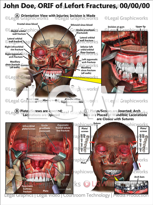 ORIF of LeFort Fractures