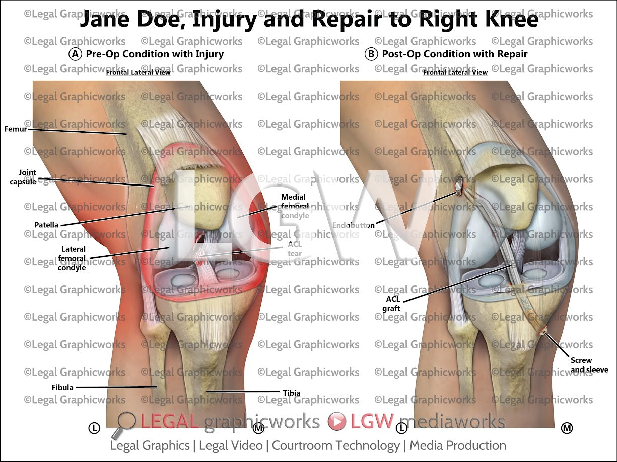 Injury and Repair to Right Knee