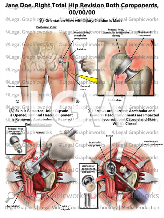 Right Total Hip Revision Both Components