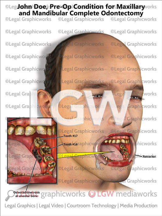 Pre-Op Condition for Maxillary and Mandibular Complete Odontectomy