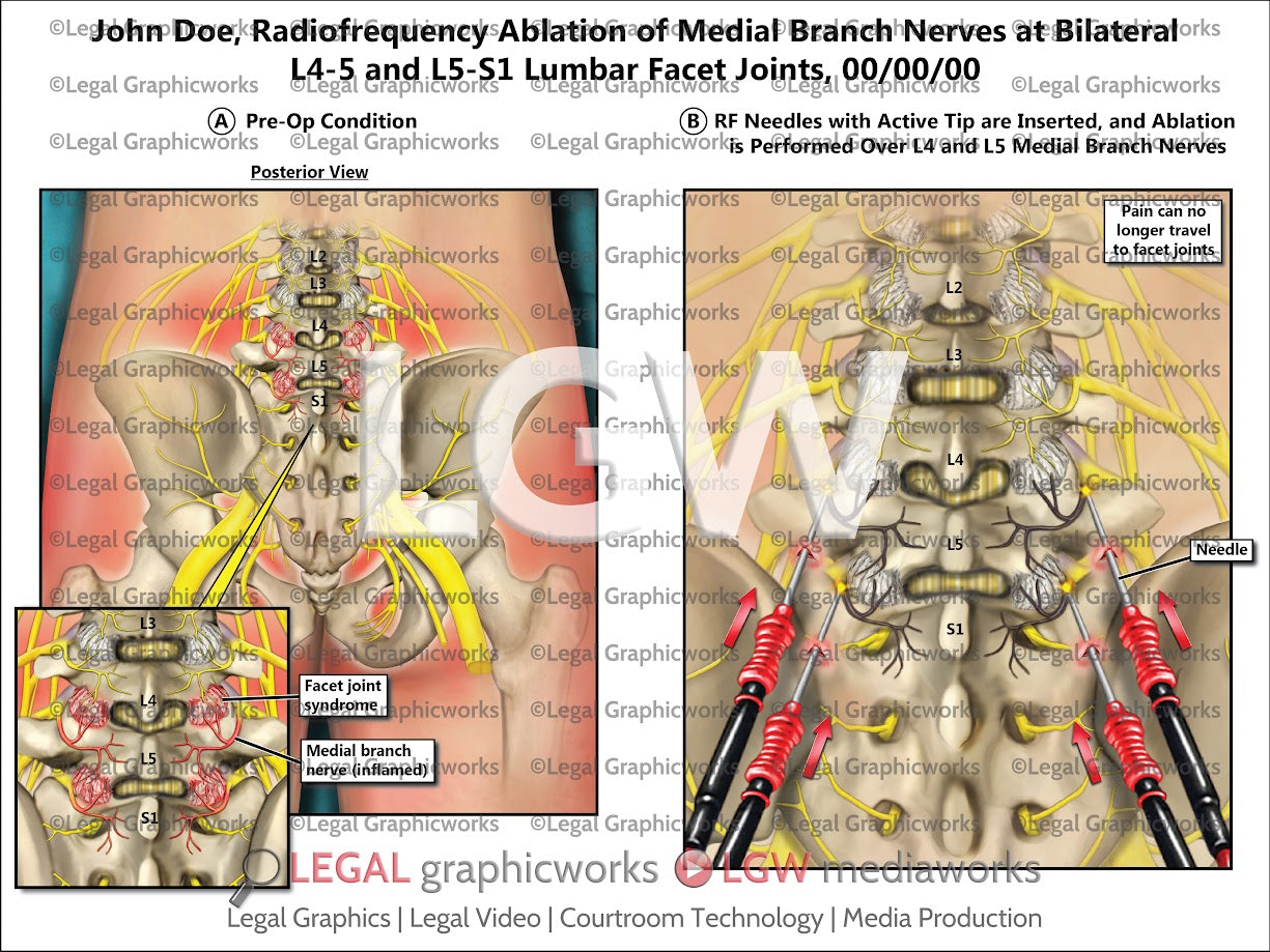 Radiofrequency Ablation of Medial Branch Nerves at Bilateral L4-5 and L5-S1 Lumbar Facet Joints