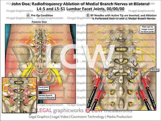 Radiofrequency Ablation of Medial Branch Nerves at Bilateral L4-5 and L5-S1 Lumbar Facet Joints