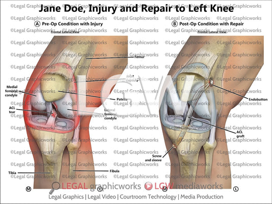 Injury and Repair to Left Knee