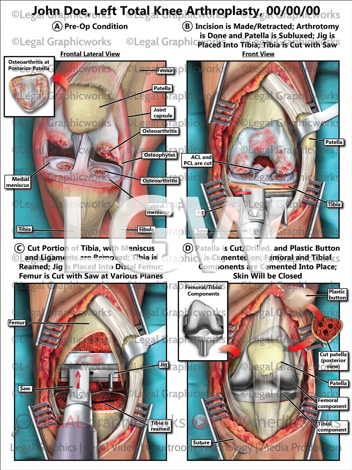 Left Total Knee Arthroplasty