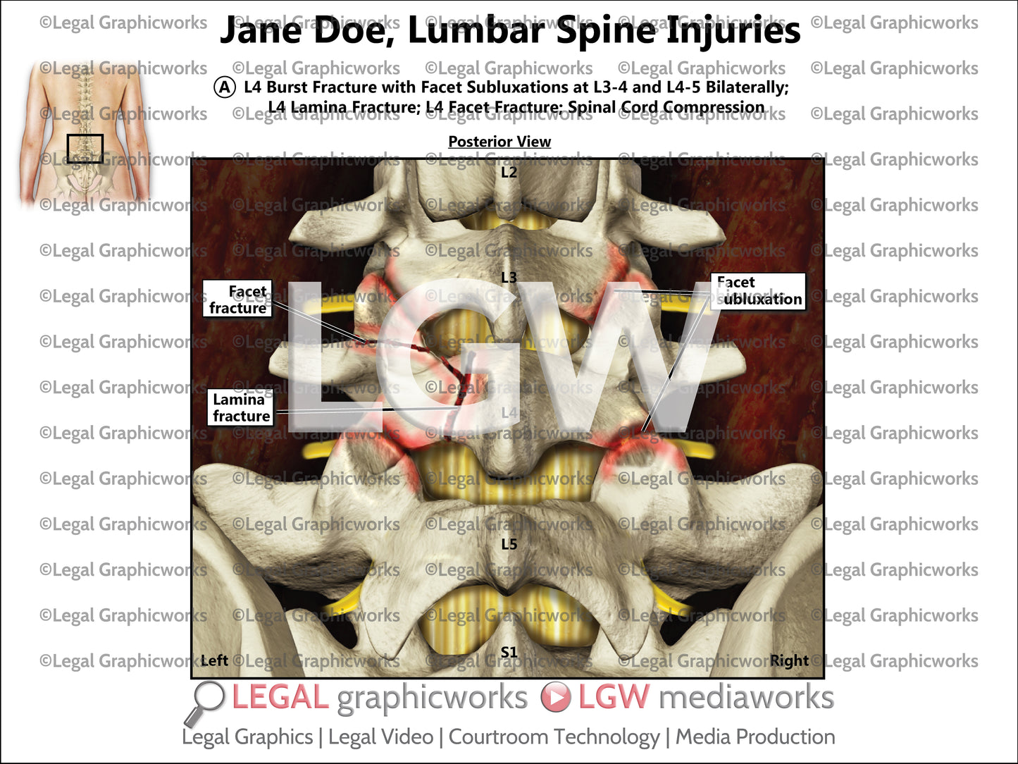Lumbar Spine Injuries