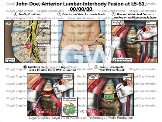 Anterior Lumbar Interbody Fusion at L5-S1