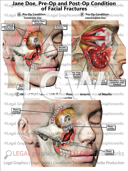 Pre-Op and Post-Op Condition of Facial Fractures