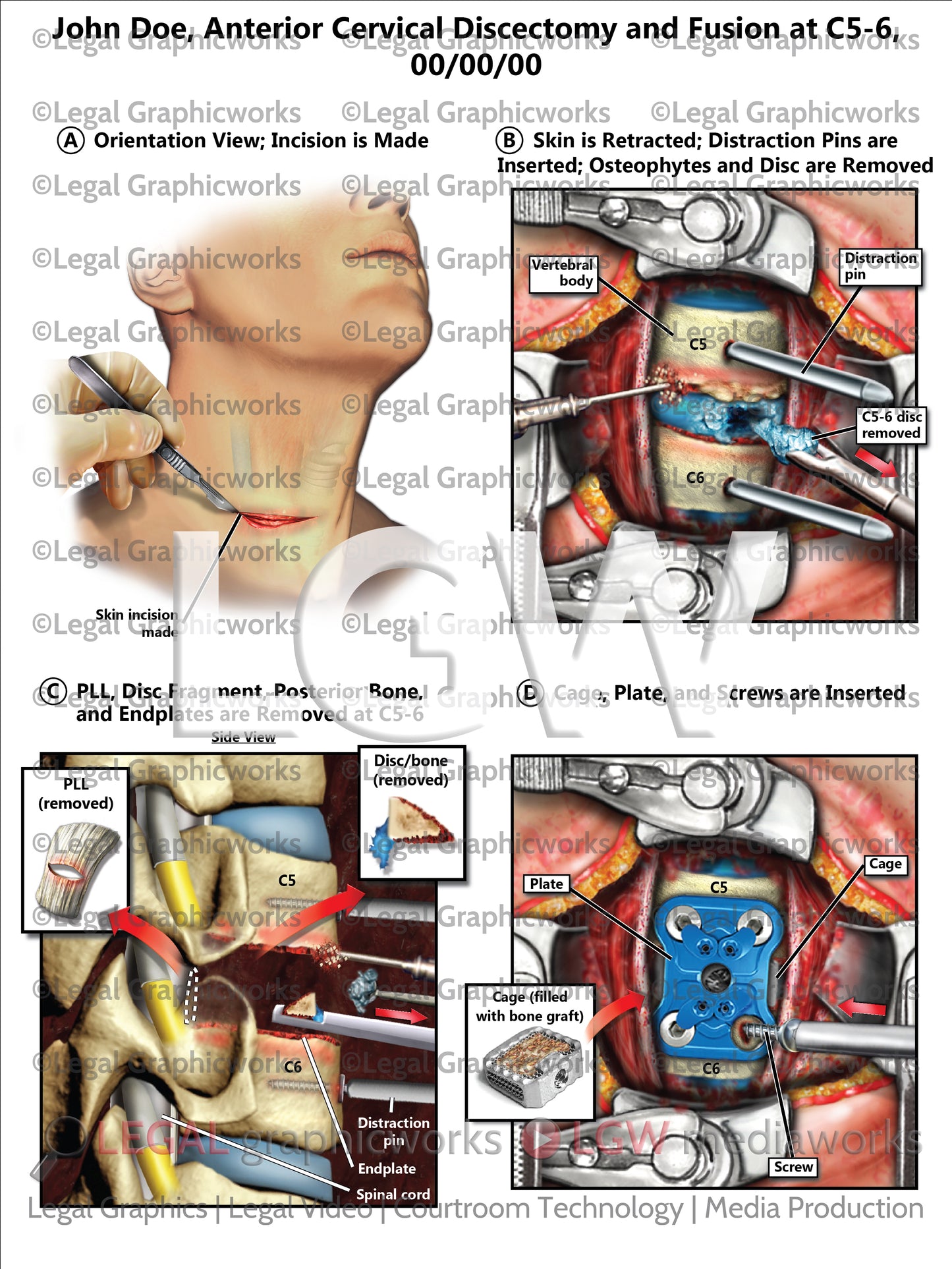 Anterior Cervical Discectomy and Fusion at C5-6