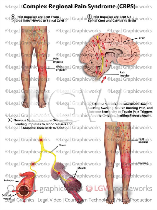 Complex Regional Pain Syndrome (CRPS)