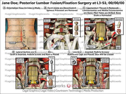 Posterior Lumbar Fusion/Fixation Surgery at L3-S1