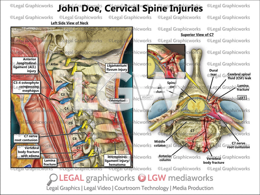 Cervical Spine Injuries
