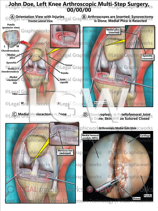 Left Knee Arthroscopic Multi-Step Surgery