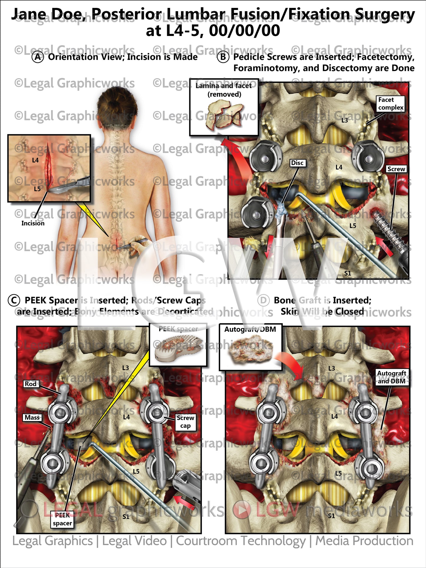 Posterior Lumbar Fusion/Fixation Surgery at L4-5