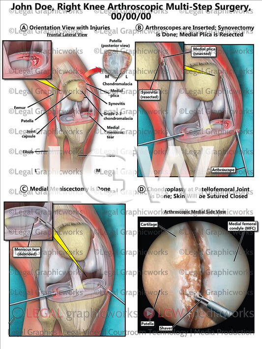 Right Knee Arthroscopic Multi-Step Surgery