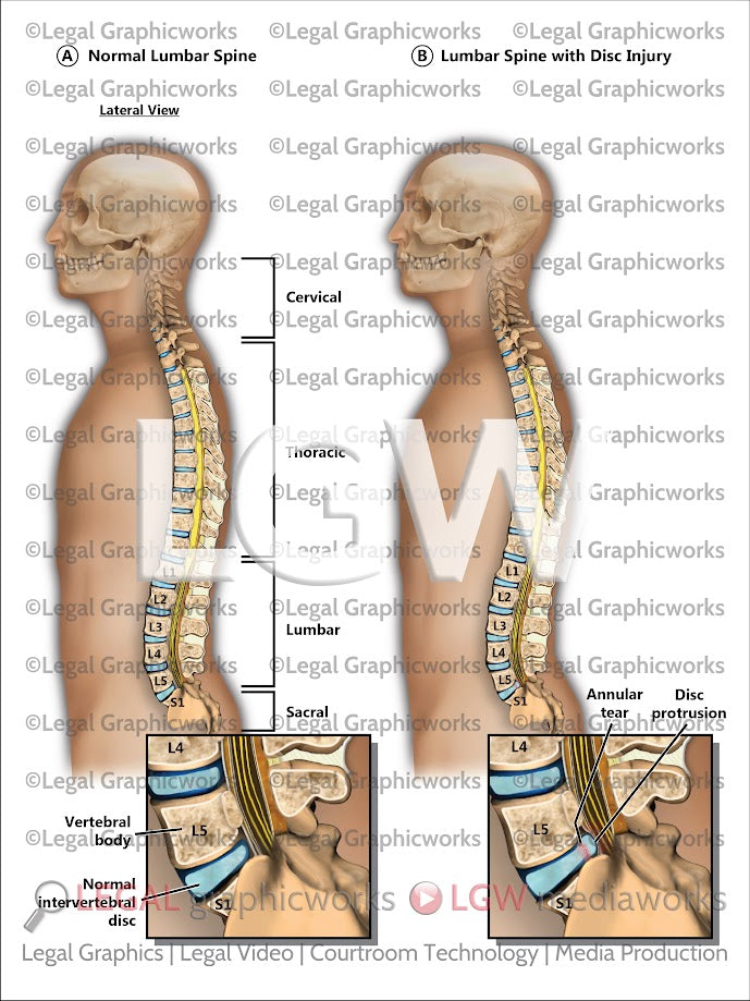 Normal Lumbar Spine vs. Lumbar Spine with Disc Injury