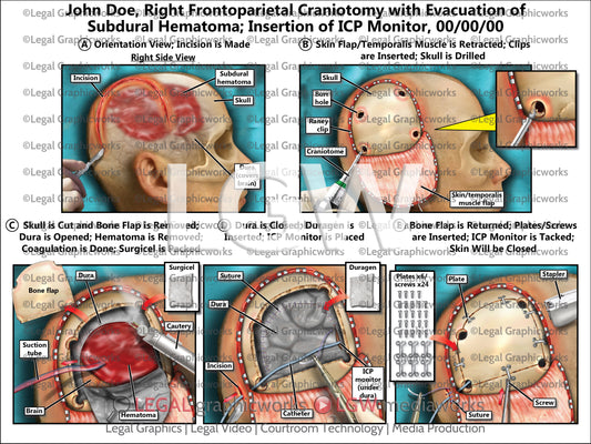 Right Frontoparietal Craniotomy with Evacuation of Subdural Hematoma; Insertion of ICP Monitor