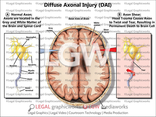 Diffuse Axonal Injury (DAI)