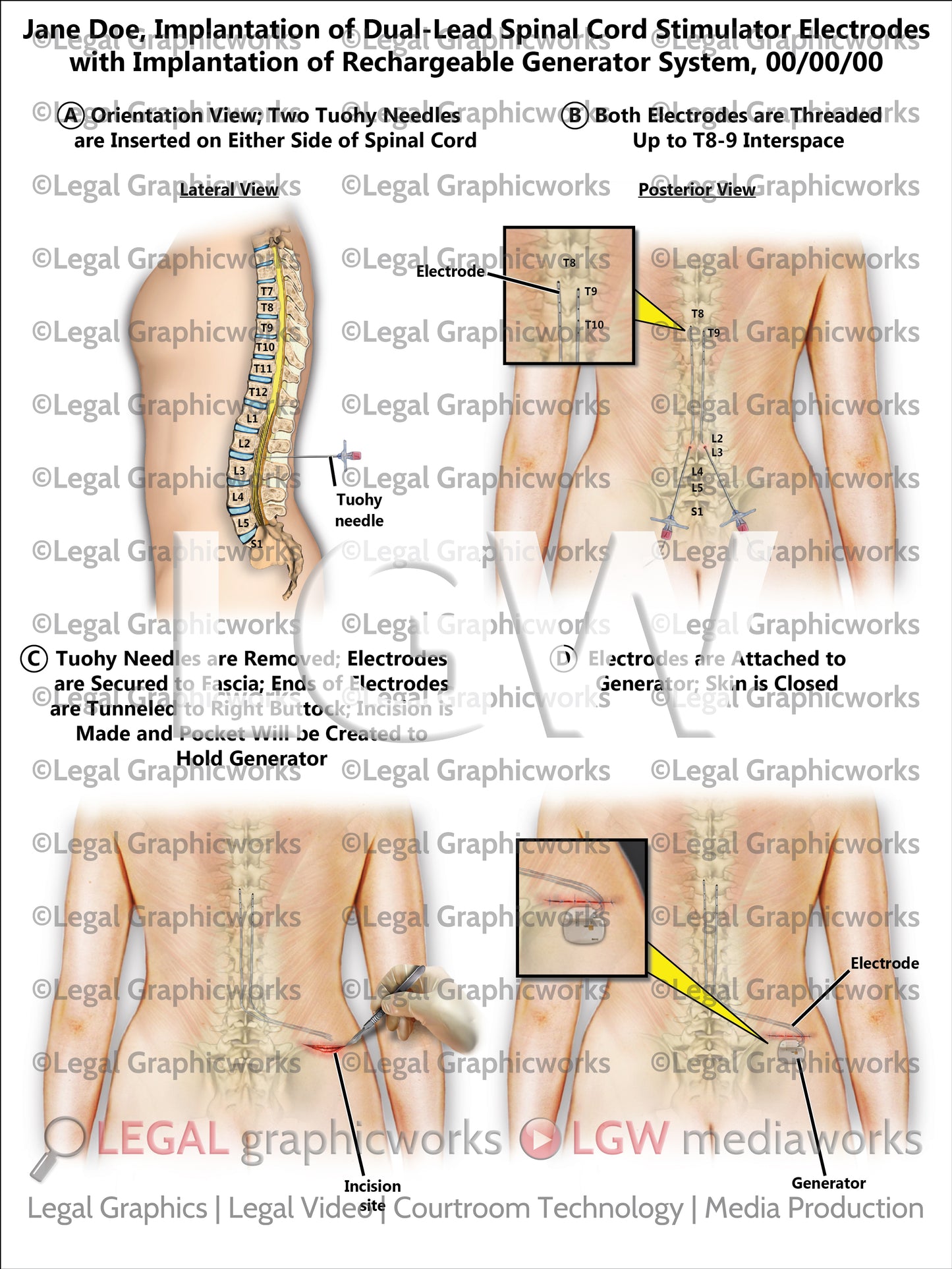 Implantation of Dual-Lead Spinal Cord Stimulator Electrodes with Implantation of Rechargeable Generator System
