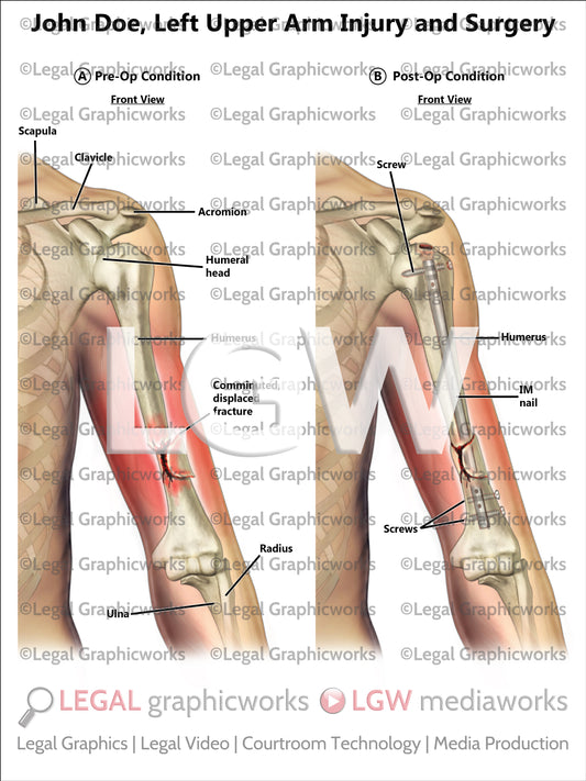 Left Upper Arm Injury and Surgery