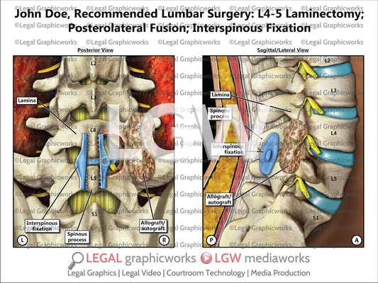 Recommended Lumbar Surgery: L4-5 Laminectomy; Posterolateral Fusion; Interspinous Fixation