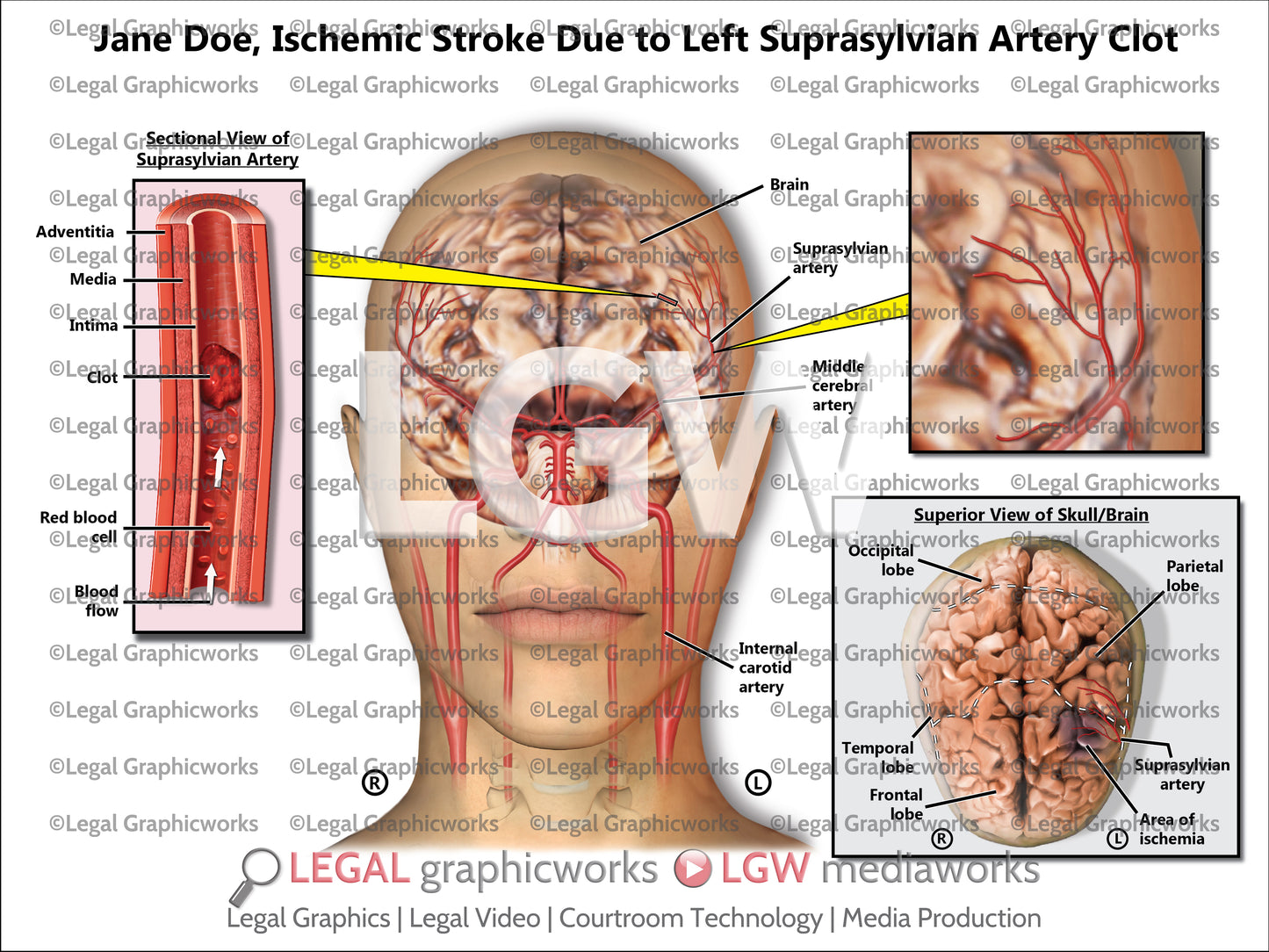 Ischemic Stroke Due to Left Suprasylvian Artery Clot